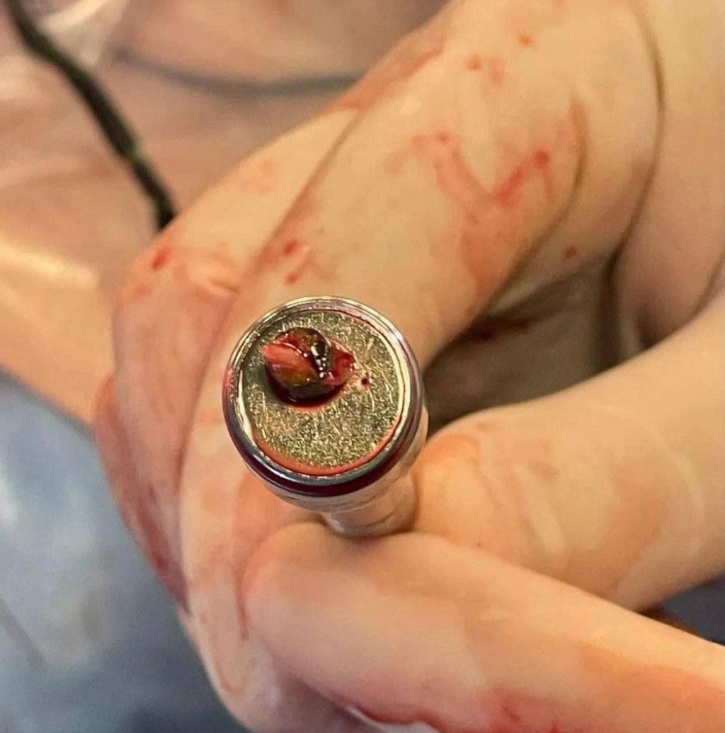 11/4/2023 – Use of magnet in heart&nbsp;surgery